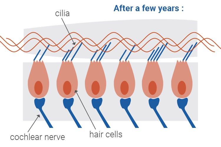 Damaged hair cells